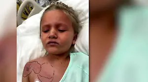 Mädchen (7) stirbt fast nach Spinnenbiss Erst nur ein kleiner „Fleck“