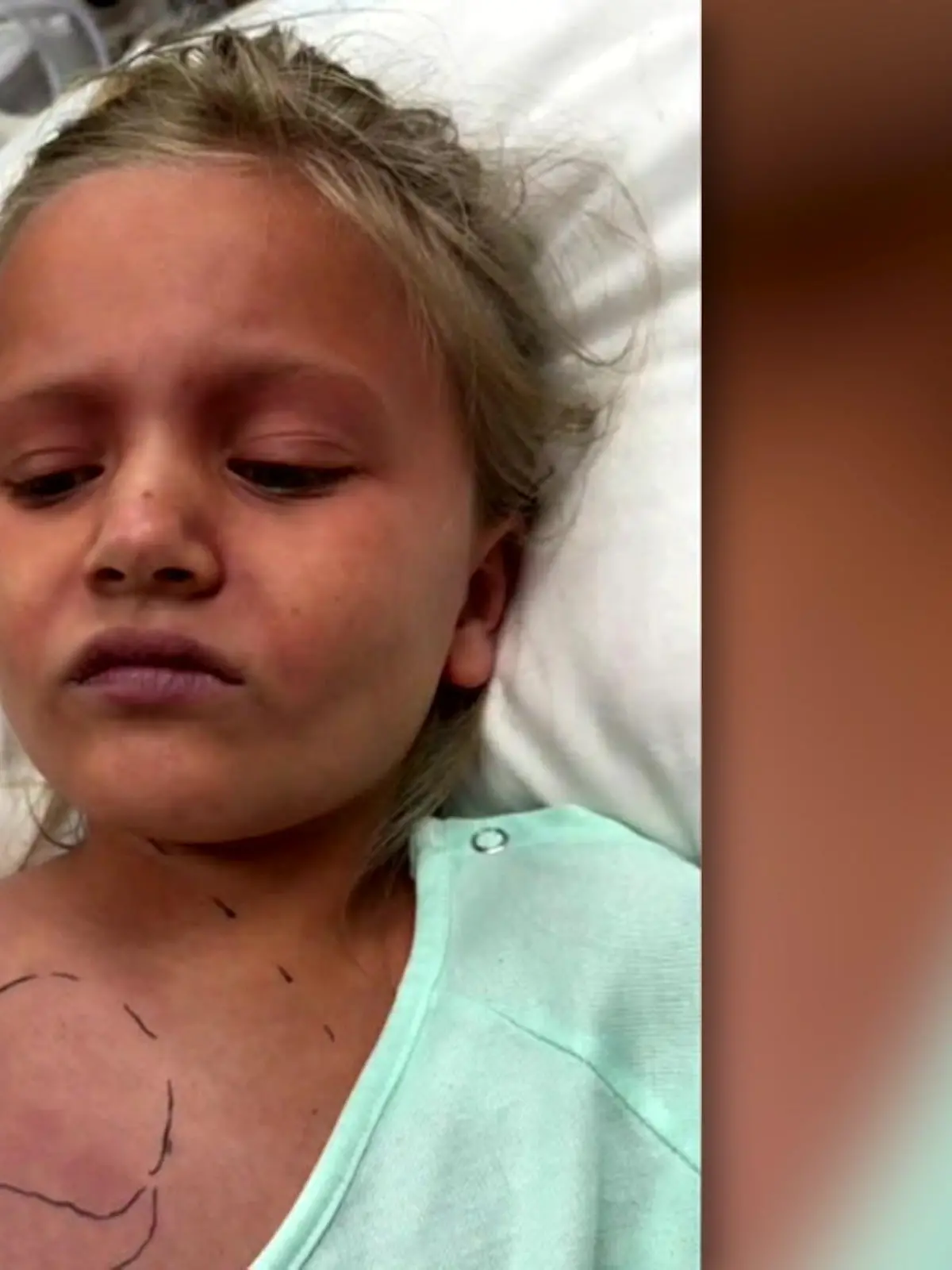 Bild zu: "Mädchen (7) stirbt fast nach Biss der Braunen Einsiedlerspinne"