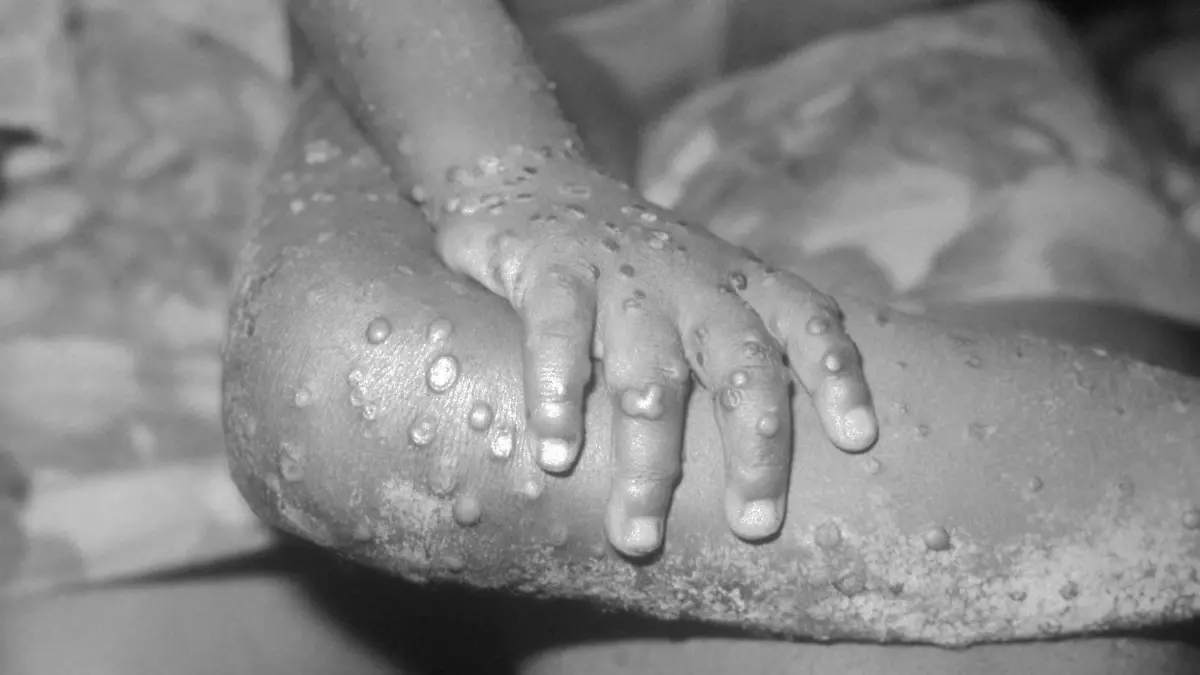 BONDUA, LIBERIA - UNDATED: In this 1971 Center For Disease Control handout photo, monkeypox-like lesions are shown on the arm and leg of a female child in Bondua, Liberia. The Centers for Disease Control and Prevention said June 7 the viral disease monkeypox, thought to be spread by prairie dogs, has been detected in the Americas for the first time with about 20 cases reported in Wisconsin, Illinois, and Indiana.  (Photo Courtesy of the CDC/Getty Images) 