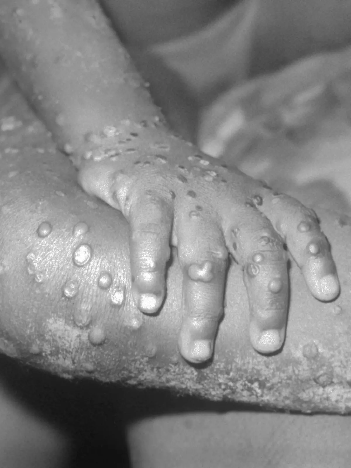 BONDUA, LIBERIA - UNDATED: In this 1971 Center For Disease Control handout photo, monkeypox-like lesions are shown on the arm and leg of a female child in Bondua, Liberia. The Centers for Disease Control and Prevention said June 7 the viral disease monkeypox, thought to be spread by prairie dogs, has been detected in the Americas for the first time with about 20 cases reported in Wisconsin, Illinois, and Indiana.  (Photo Courtesy of the CDC/Getty Images) 
