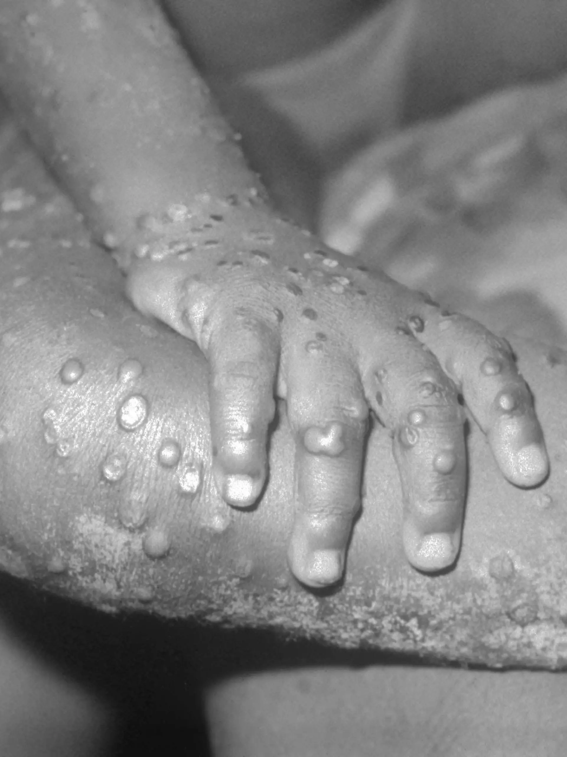BONDUA, LIBERIA - UNDATED: In this 1971 Center For Disease Control handout photo, monkeypox-like lesions are shown on the arm and leg of a female child in Bondua, Liberia. The Centers for Disease Control and Prevention said June 7 the viral disease monkeypox, thought to be spread by prairie dogs, has been detected in the Americas for the first time with about 20 cases reported in Wisconsin, Illinois, and Indiana.  (Photo Courtesy of the CDC/Getty Images) 