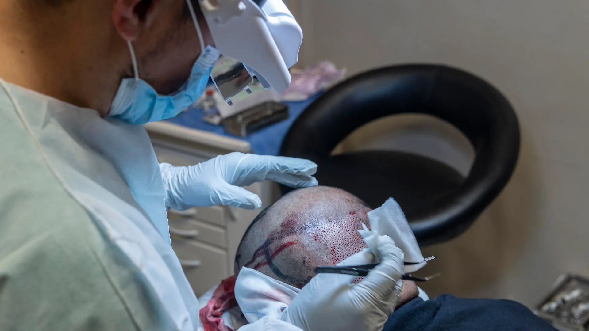 Chirurgen im Operationssaal führen eine Haartransplantation durch. (Symbolbild)
