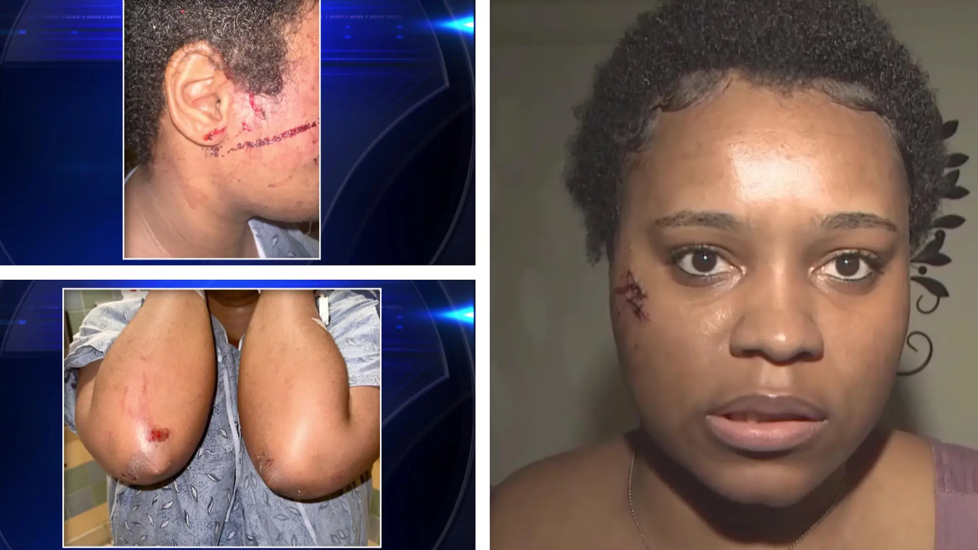 Als sie plötzlich Schreie hört, will Imani Barrett aus Florida helfen - doch dann stürzt sich der Pitbull auf sie, beißt in ihr Gesicht und in den Rücken.