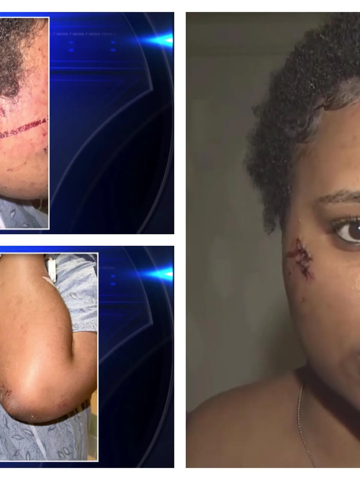Als sie plötzlich Schreie hört, will Imani Barrett aus Florida helfen - doch dann stürzt sich der Pitbull auf sie, beißt in ihr Gesicht und in den Rücken.