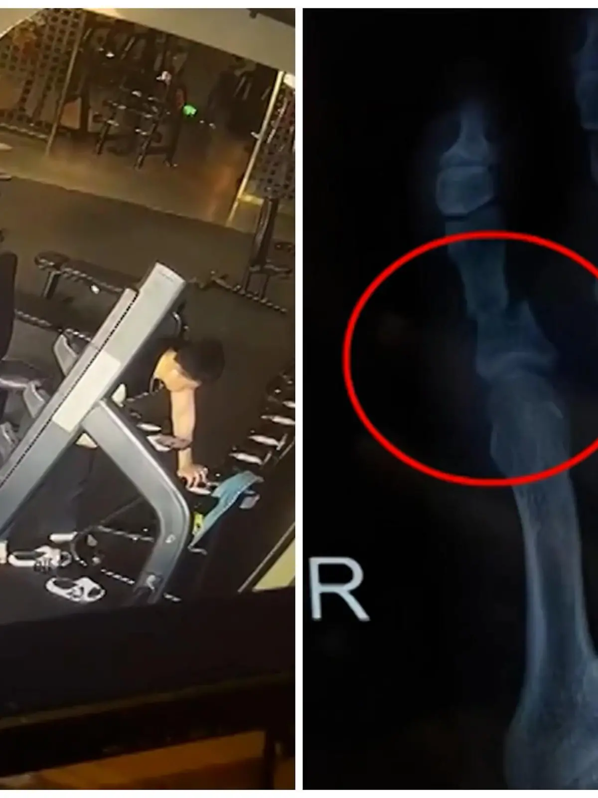 Denn als einem Mann in einem chinesischen Fitnessstudio plötzlich das Gewicht von der Hantelstange fällt, ist der Schmerz groß. Die Hantel fällt seinem Nachbarn direkt auf den Fuß und verletzt ihn dabei.