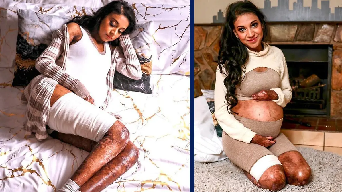 Die dreifache Mutter Shirvani Naran (35) aus Südafrika hat die Schmetterlingskrankheit Epidermolysis bullosa.
