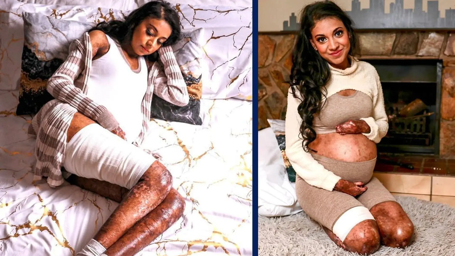 Die dreifache Mutter Shirvani Naran (35) aus Südafrika hat die Schmetterlingskrankheit Epidermolysis bullosa.