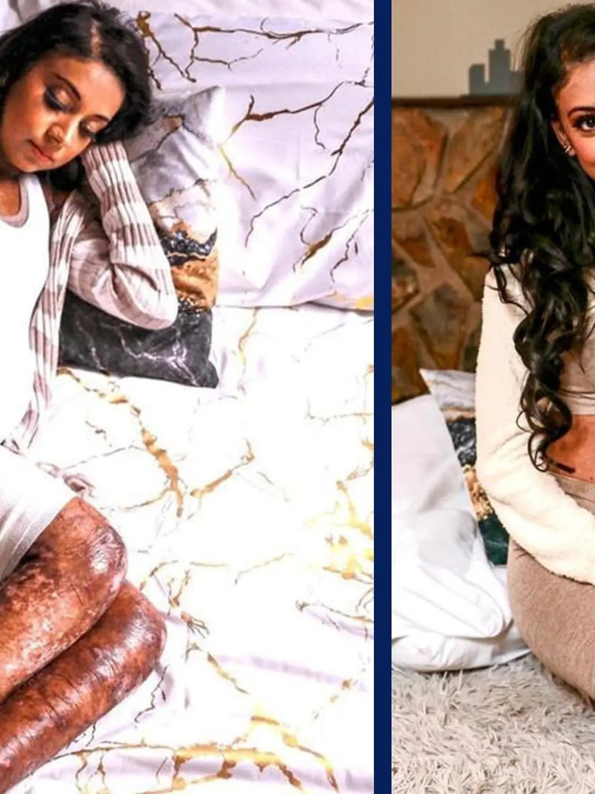 Die dreifache Mutter Shirvani Naran (35) aus Südafrika hat die Schmetterlingskrankheit Epidermolysis bullosa.