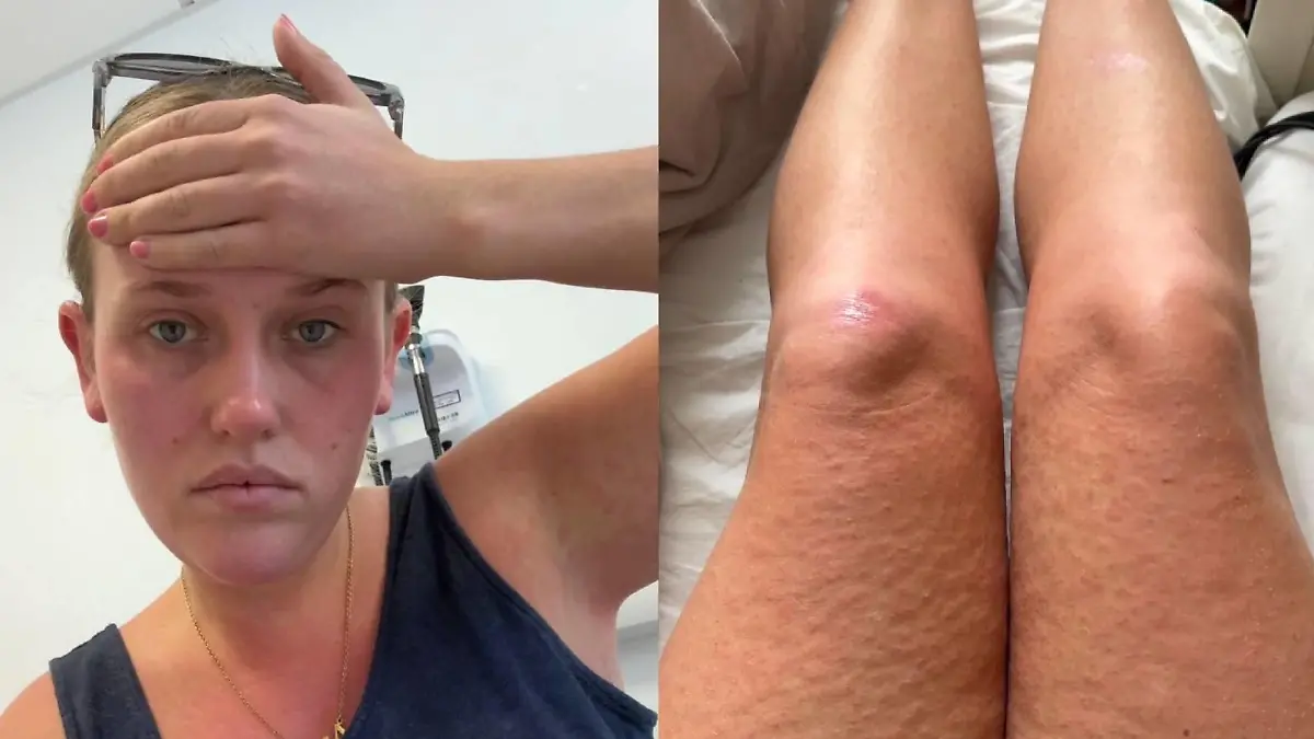 Diagnose Dengue-Fieber: Emma Cox aus Großbritannien hatte grippeähnliche Symptome und Hautausschlag.