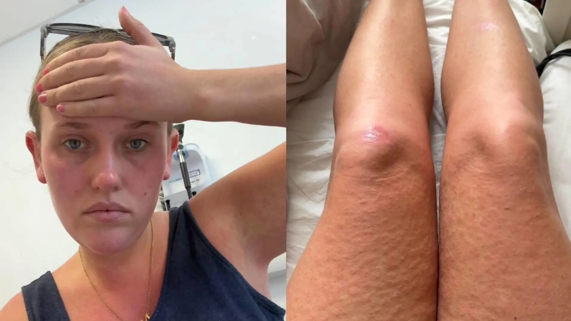 Diagnose Dengue-Fieber: Emma Cox aus Großbritannien hatte grippeähnliche Symptome und Hautausschlag.