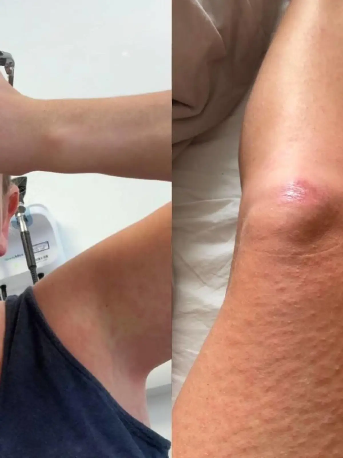 Diagnose Dengue-Fieber: Emma Cox aus Großbritannien hatte grippeähnliche Symptome und Hautausschlag.