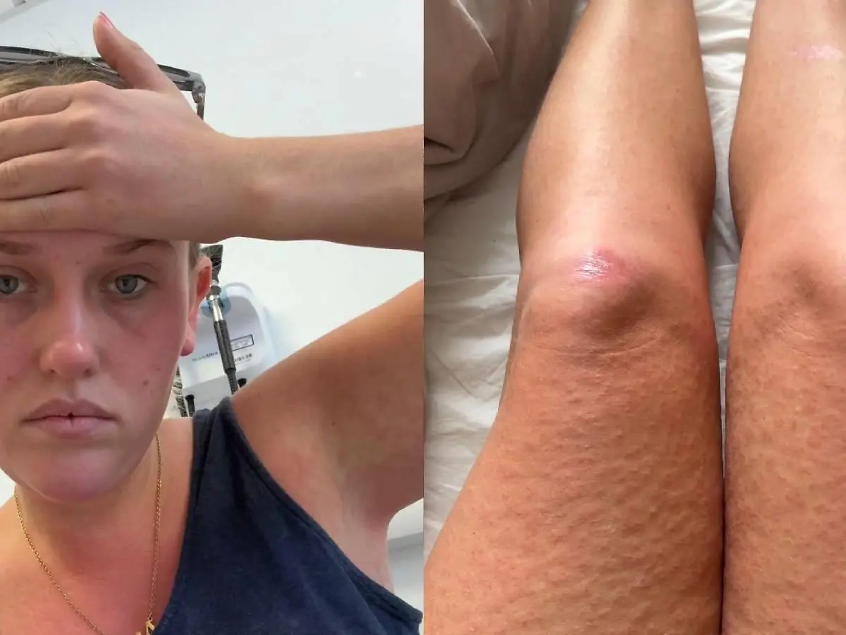 Ich dachte, es wre eine Grippe: Britin erkrankt an tropischem  Dengue-Fieber