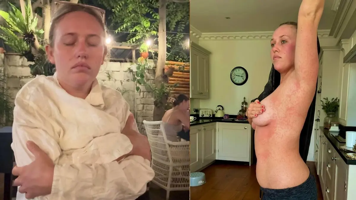 Emma Cox hatte Kopf-, Gelenkschmerzen und  bekam nach dem Abklingen der ersten Symptome einen Hautausschlag am ganzen Körper.