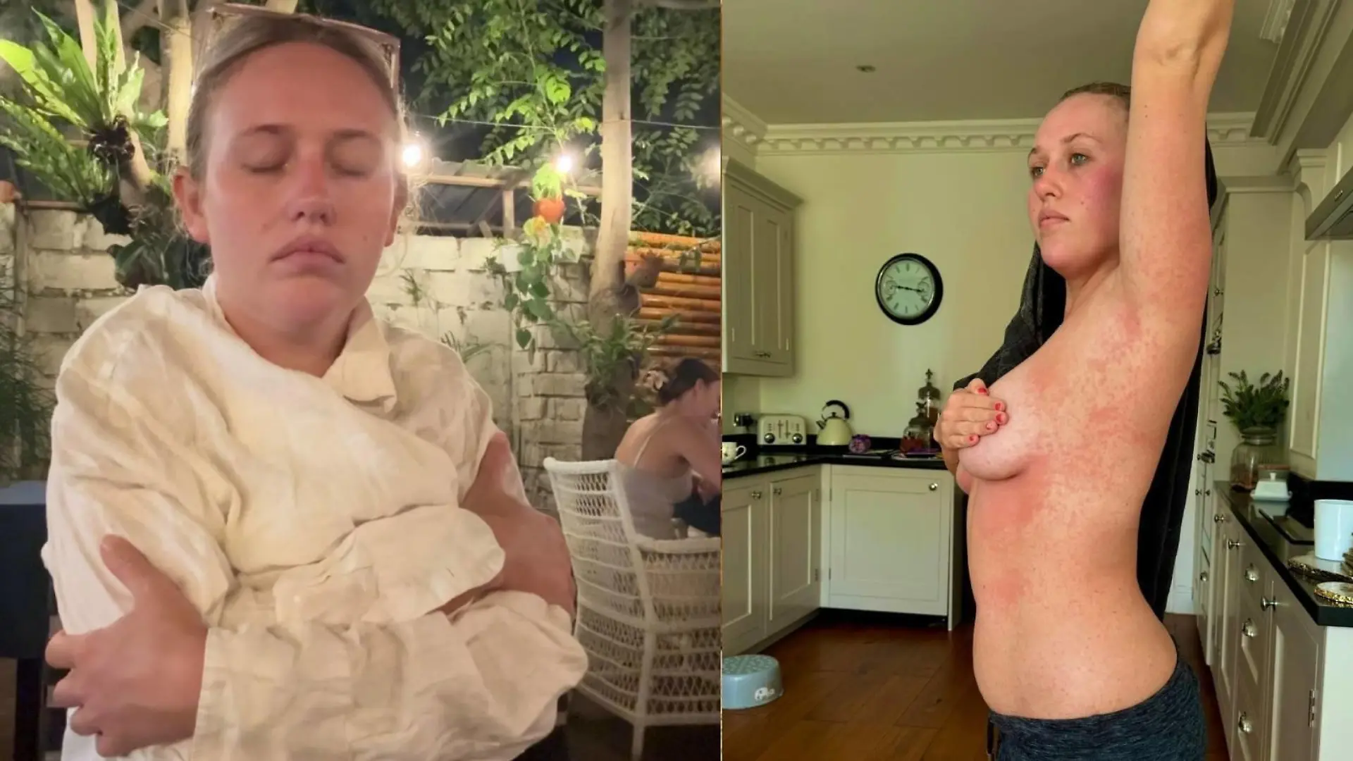 Emma Cox hatte Kopf-, Gelenkschmerzen und bekam nach dem Abklingen der ersten Symptome einen Hautausschlag am ganzen Körper.
