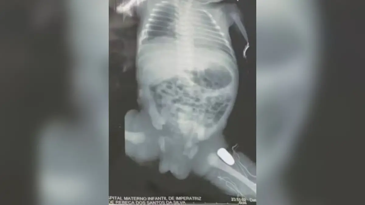 Die Kugel hatte das linke Bein des Babys im Bauch getroffen.