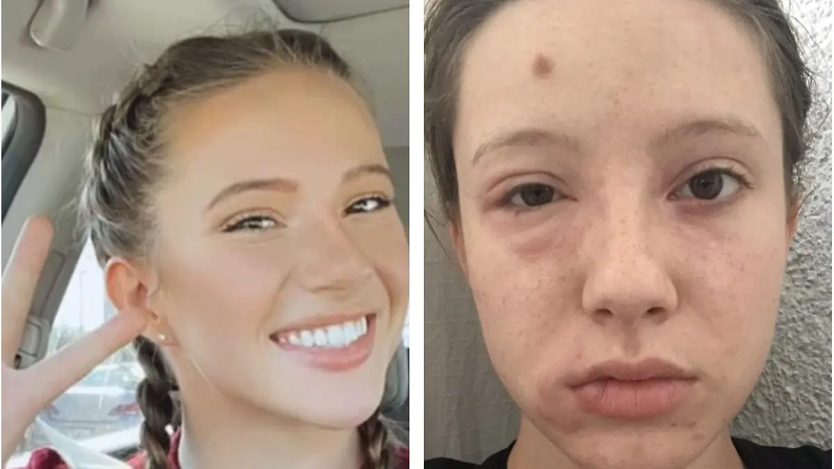 Gracie Pfaff (22) leidet an einer Aluminium-Allergie.