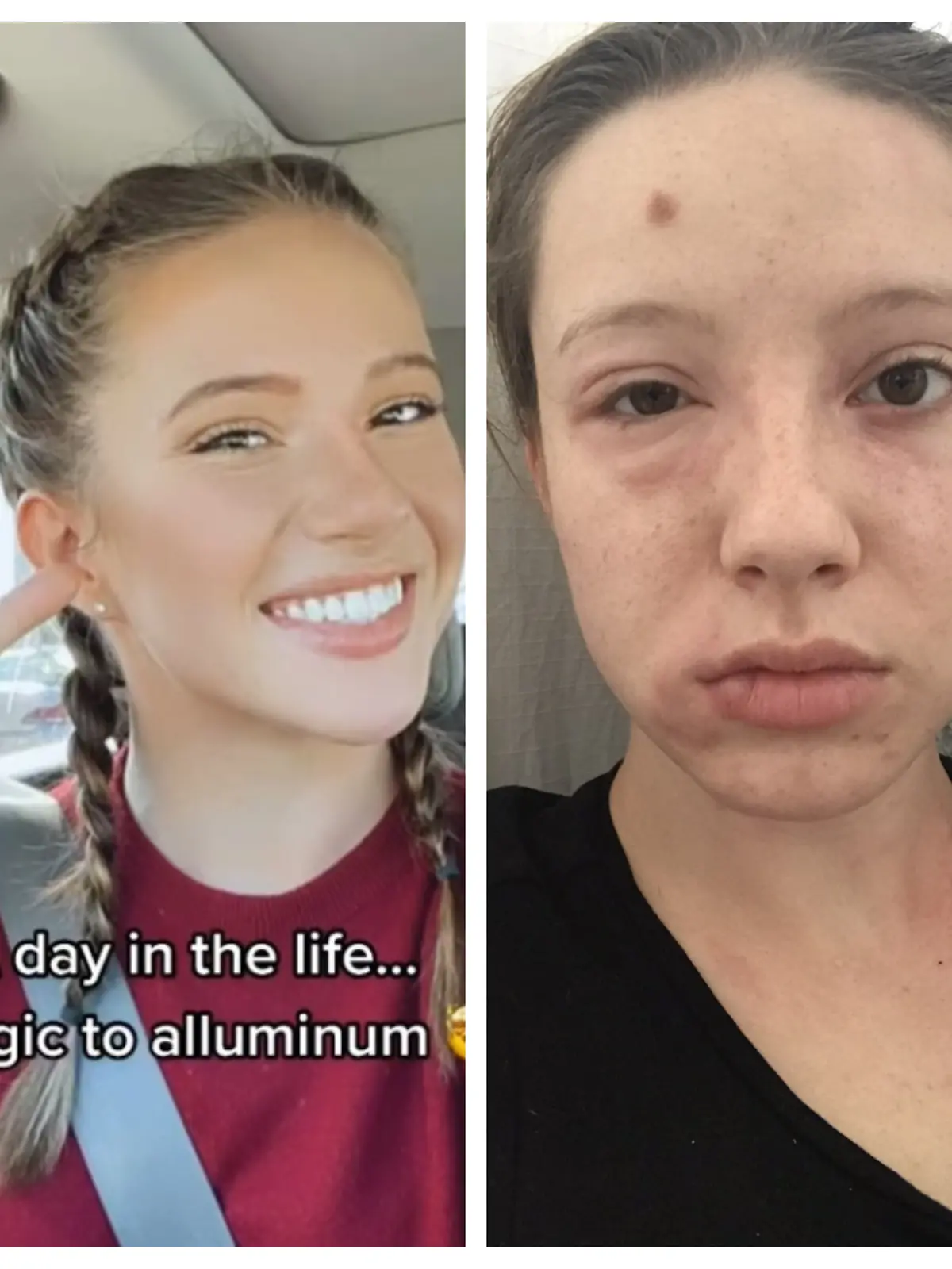Gracie Pfaff (22) leidet an einer Aluminium-Allergie.