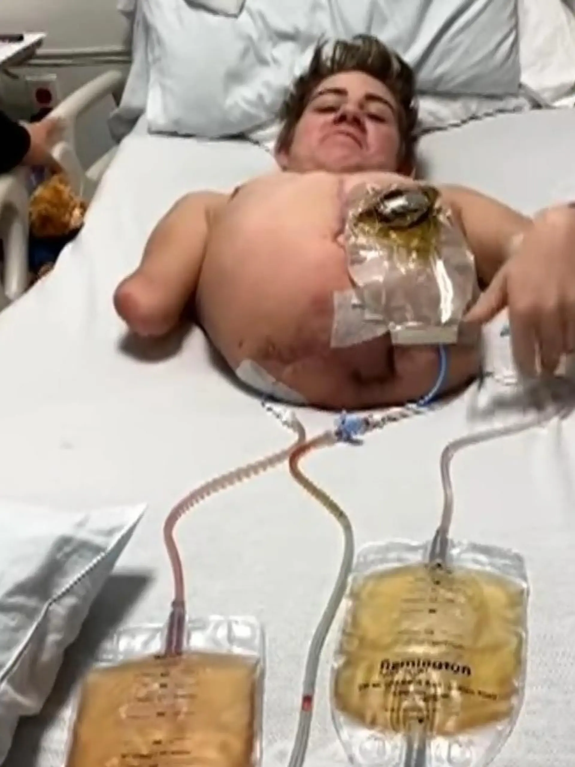 Gabelstapler-Unfall Loren Schauers