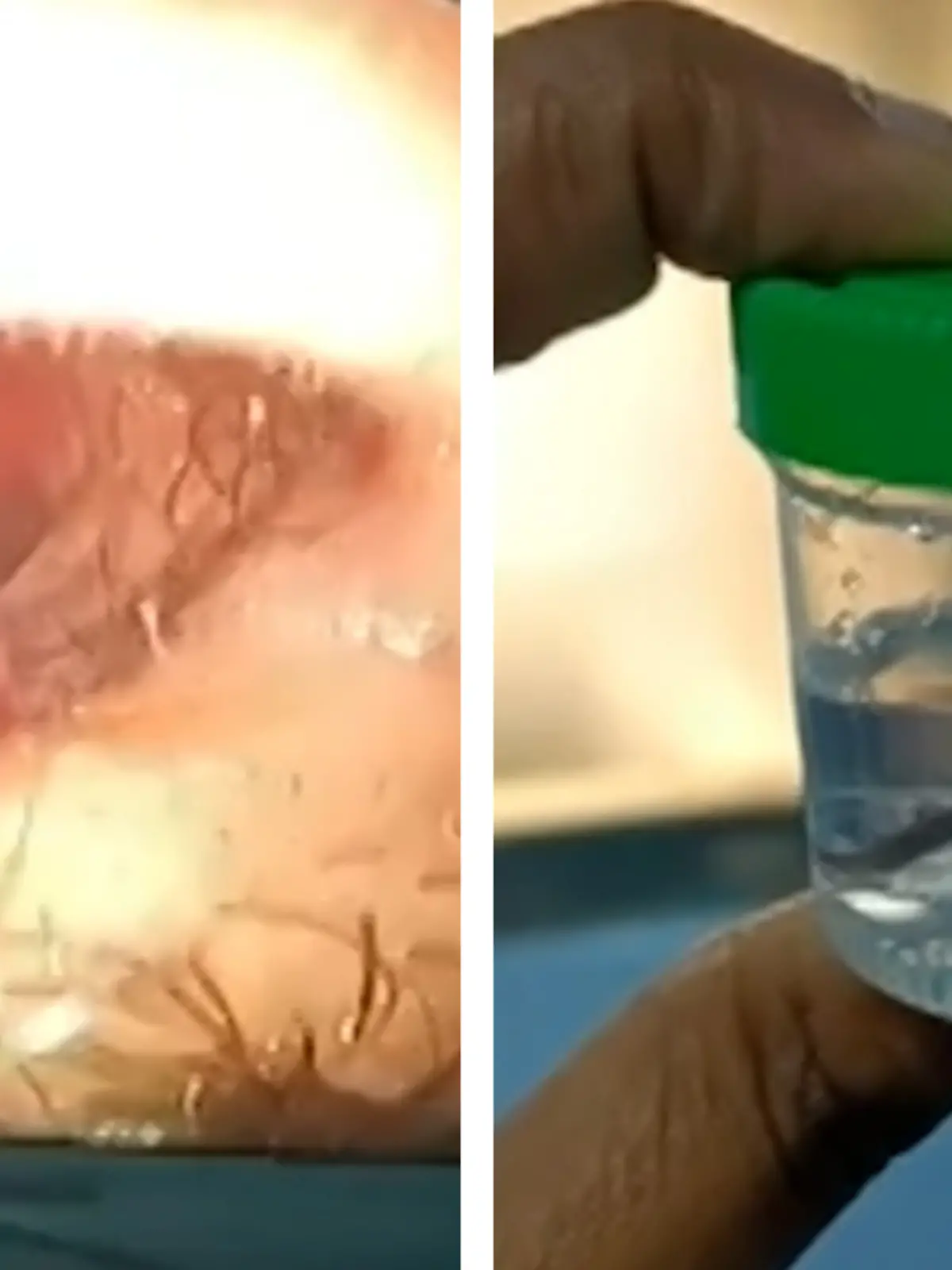 Bild zu: "Wie EGELig! Arzt fischt lebendigen Parasiten aus Patienten-Nase"