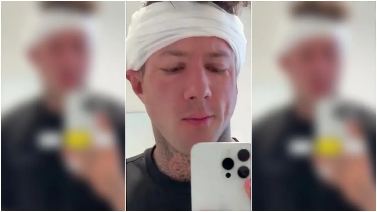 Christian Wolf hat eine Haartransplantation machen lassen.