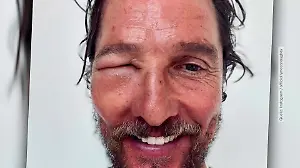 Schockierendes Bild von Matthew McConaughey. Deshalb ist sein Auge zugeschwollen