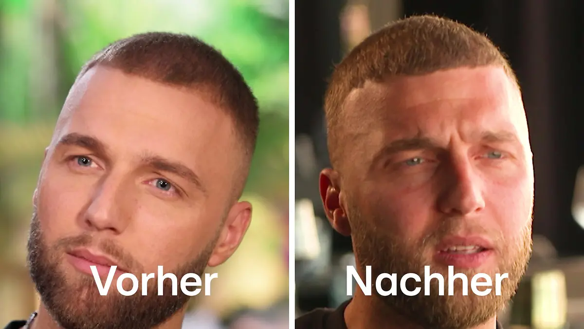 Filip vor und nach seiner Haartransplantation. 