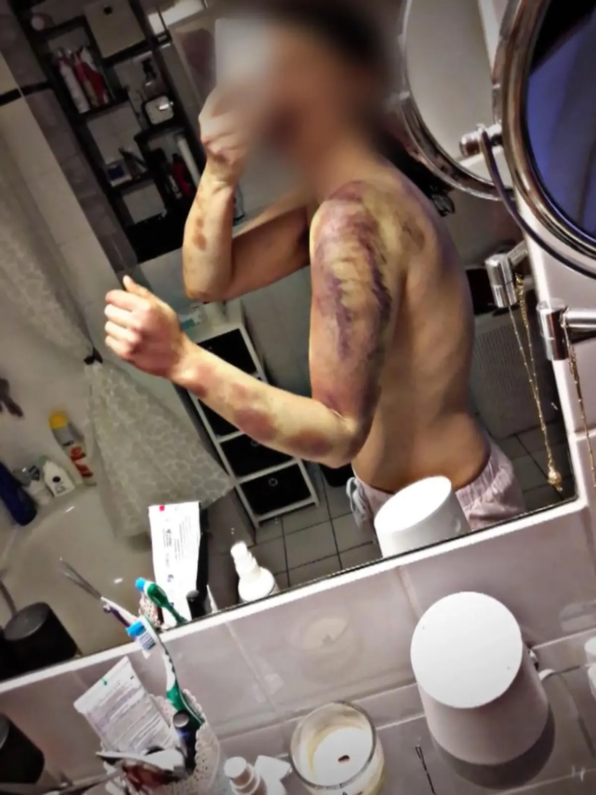 Die blauen Flecken auf Manuelas Körper sind nicht zu übersehen.