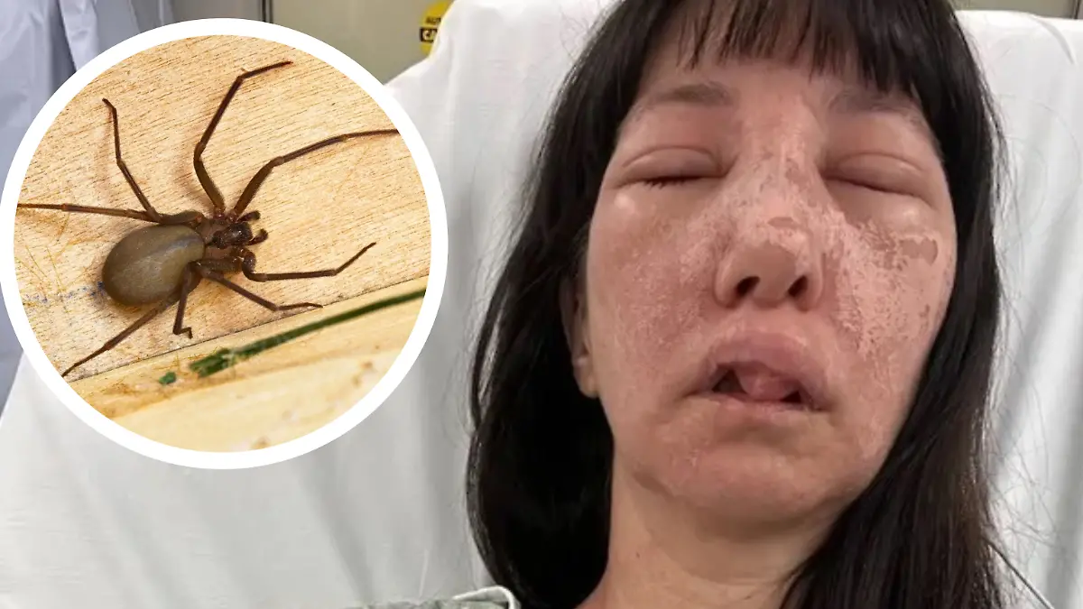 Jessica Rogue (44) wollte eigentlich nur ihren Schuppen aufräumen. Dann wurde sie von der Braunen Einsiedlerspinne angegriffen.
