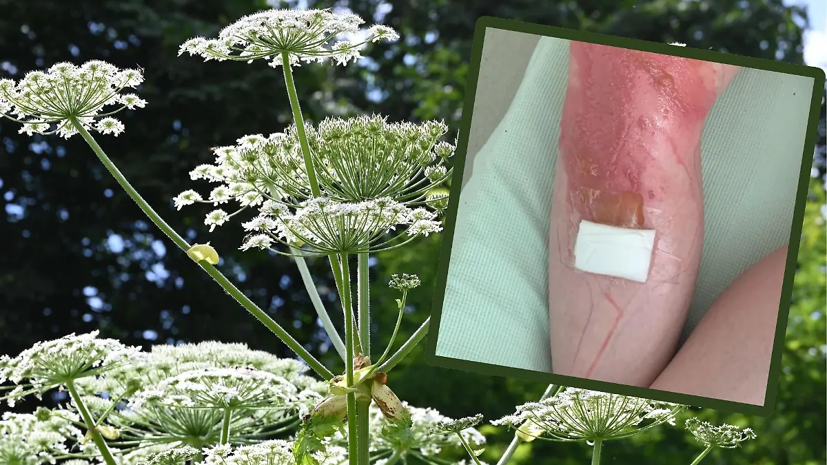 Sieht deutlich harmloser aus, als sie ist: Die Herkulesstaude bzw. Riesenbärenklau. Wie schlimm der Kontakt sein kann, zeigt der Fall von Michael (kl. Foto).