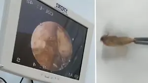 Motte krabbelt ins Ohr – Patient wusste nichts davon. Arzt macht eklige Entdeckung!