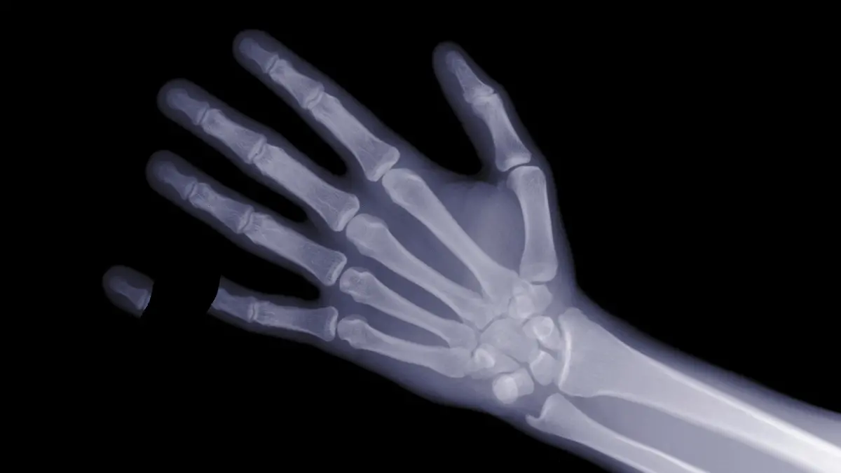 Eine Röntgenhand, der kleine Finger ist ab. 