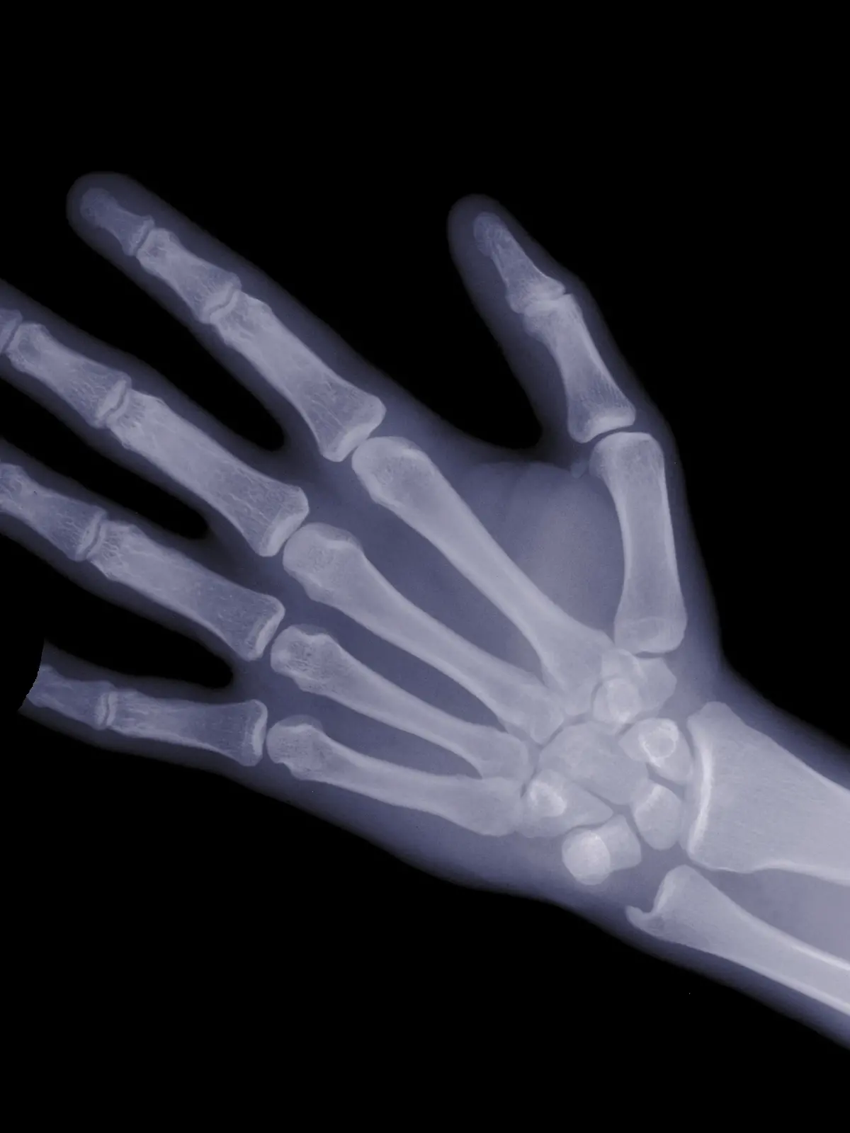 Eine Röntgenhand, der kleine Finger ist ab. 