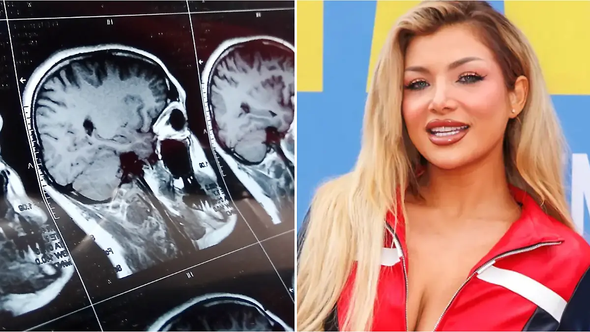 Ex-DSDS-Kandidatin Melody Haase hat „eine Krankheit, die einfach unnormal wehtut”. Eine Hirn-OP könnte dauerhaft helfen.