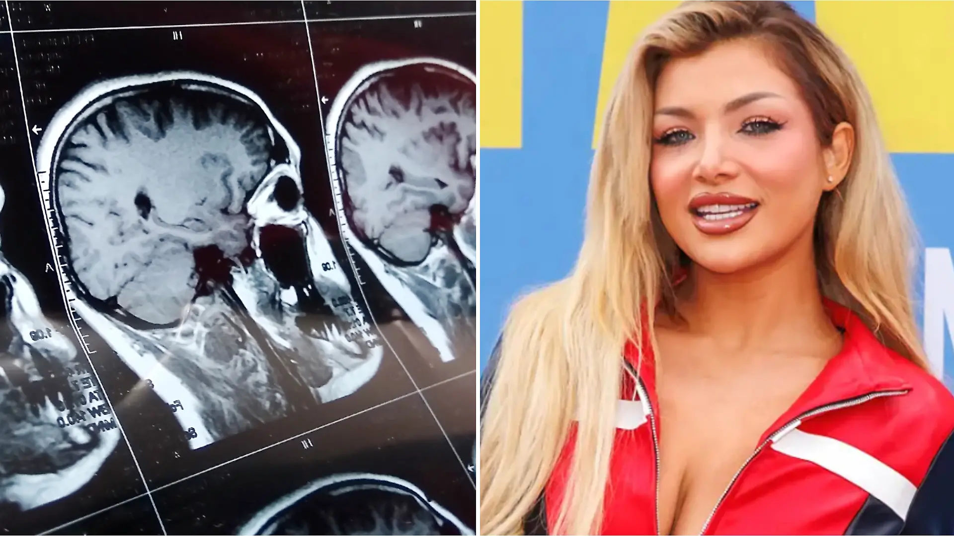 Ex-DSDS-Kandidatin Melody Haase hat „eine Krankheit, die einfach unnormal wehtut”. Eine Hirn-OP könnte dauerhaft helfen.