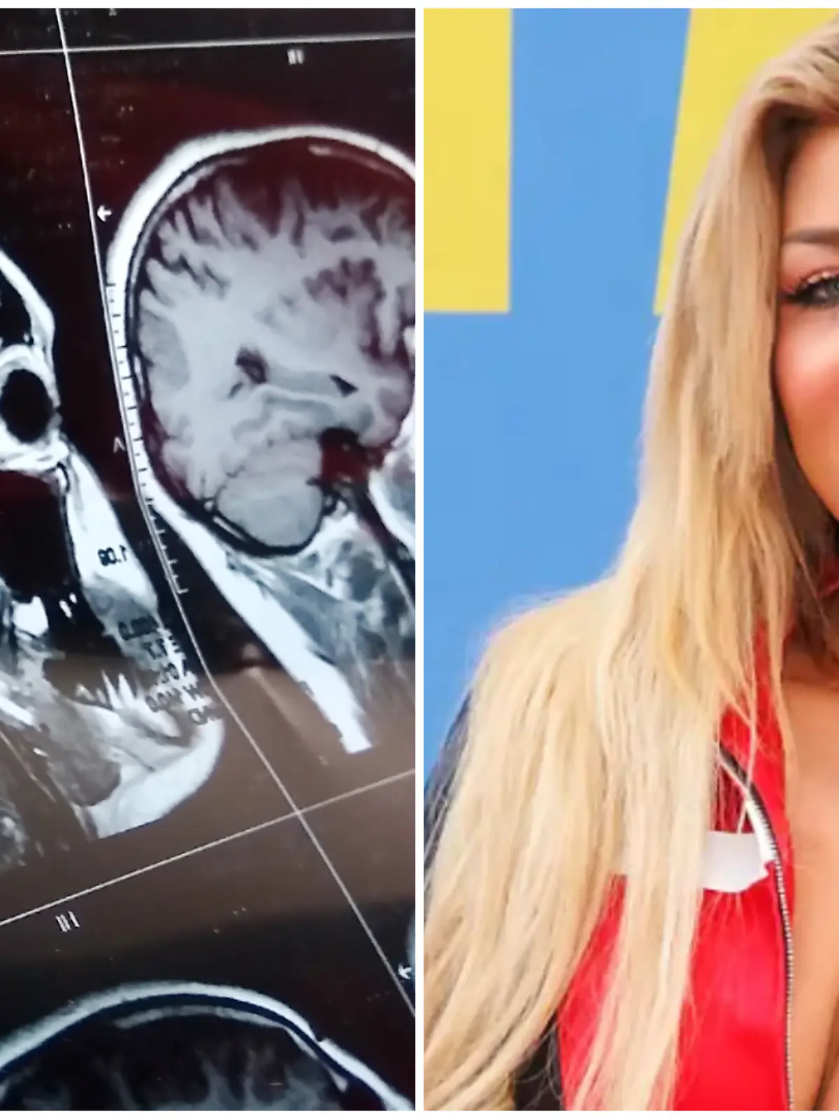 Ex-DSDS-Kandidatin Melody Haase hat „eine Krankheit, die einfach unnormal wehtut”. Eine Hirn-OP könnte dauerhaft helfen.