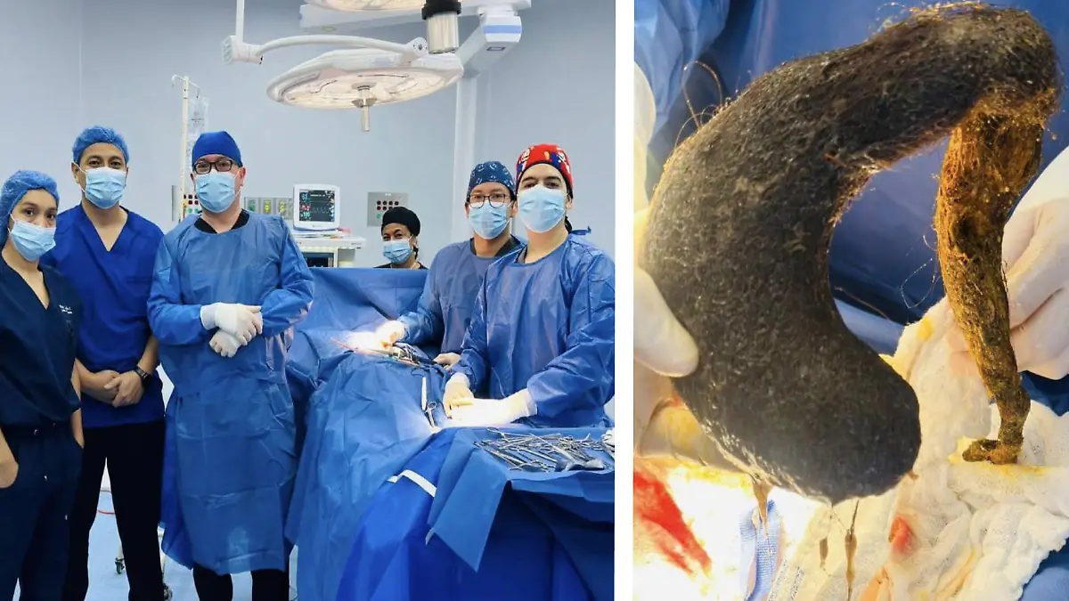 Ecuador: Ärzte holen rieisgen Haarbüschel aus Magen einer 24-Jährigen.