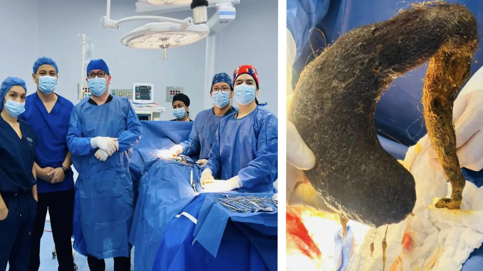 Frau (24) hat ständig Bauchschmerzen - Ärzte operieren riesigen Haarballen aus Magen