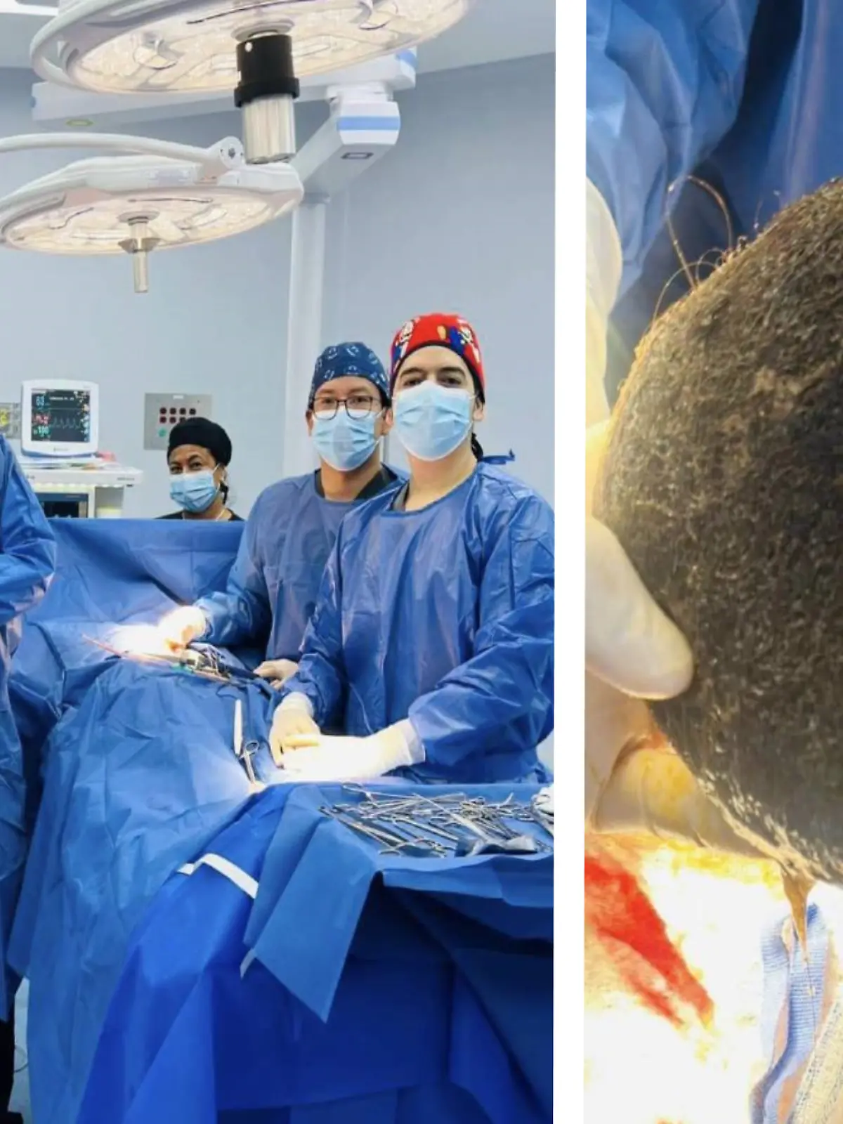 Ecuador: Ärzte holen rieisgen Haarbüschel aus Magen einer 24-Jährigen.