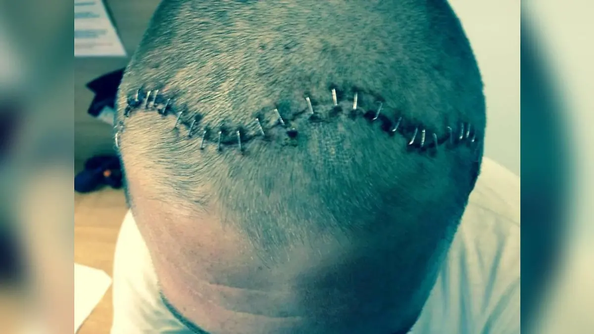 Shaun Turner aus Großbritannien hat einen Hirntumor.