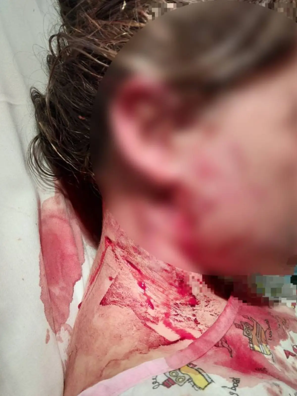 Bild zu: "Mädchen (10) von XL Bully angegriffen – Foto zeigt schreckliche Verletzung!"