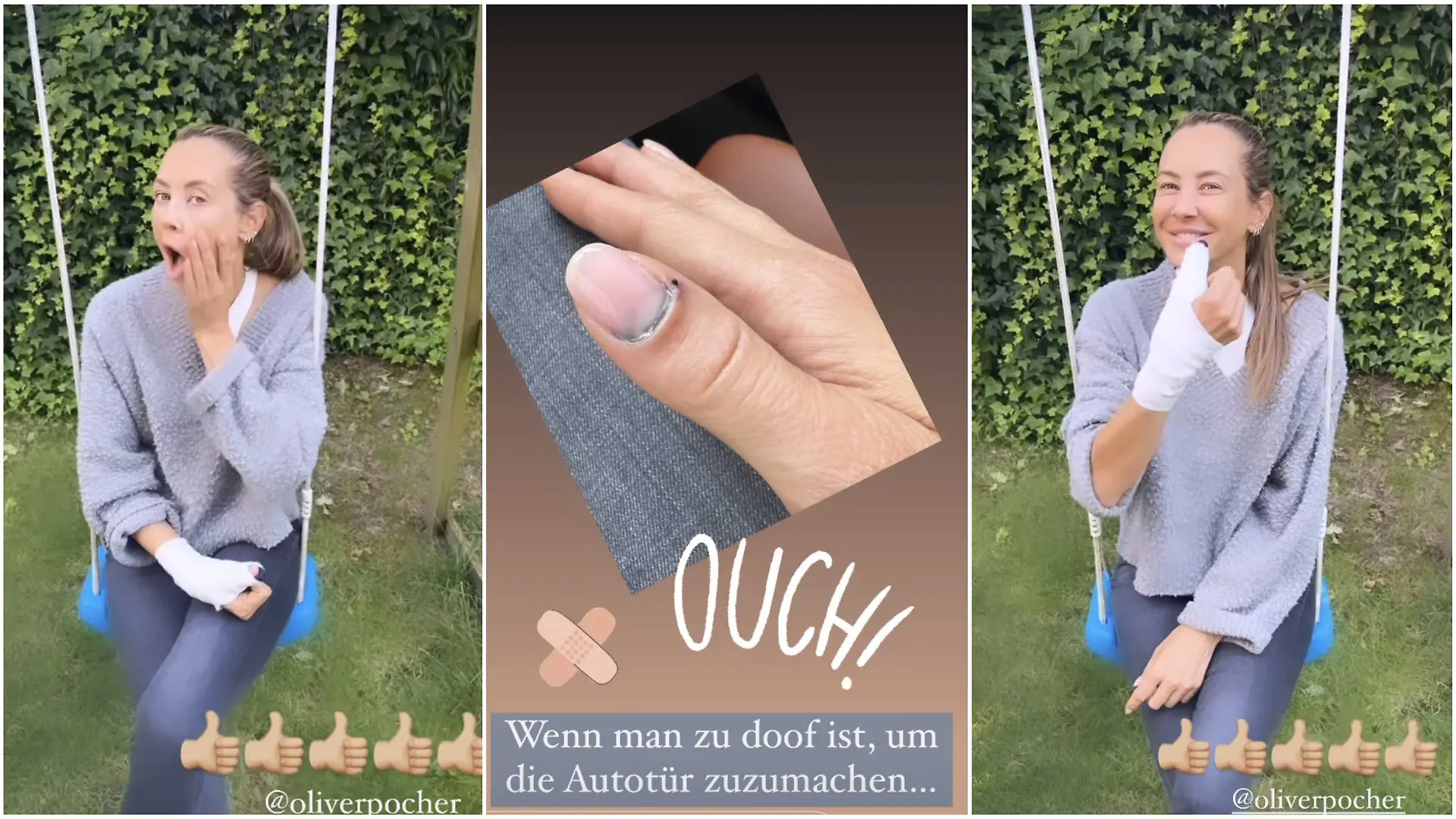 Daumen hoch: Sandy Meyer-Wölden nimmt ihre Verletzung mit Humor