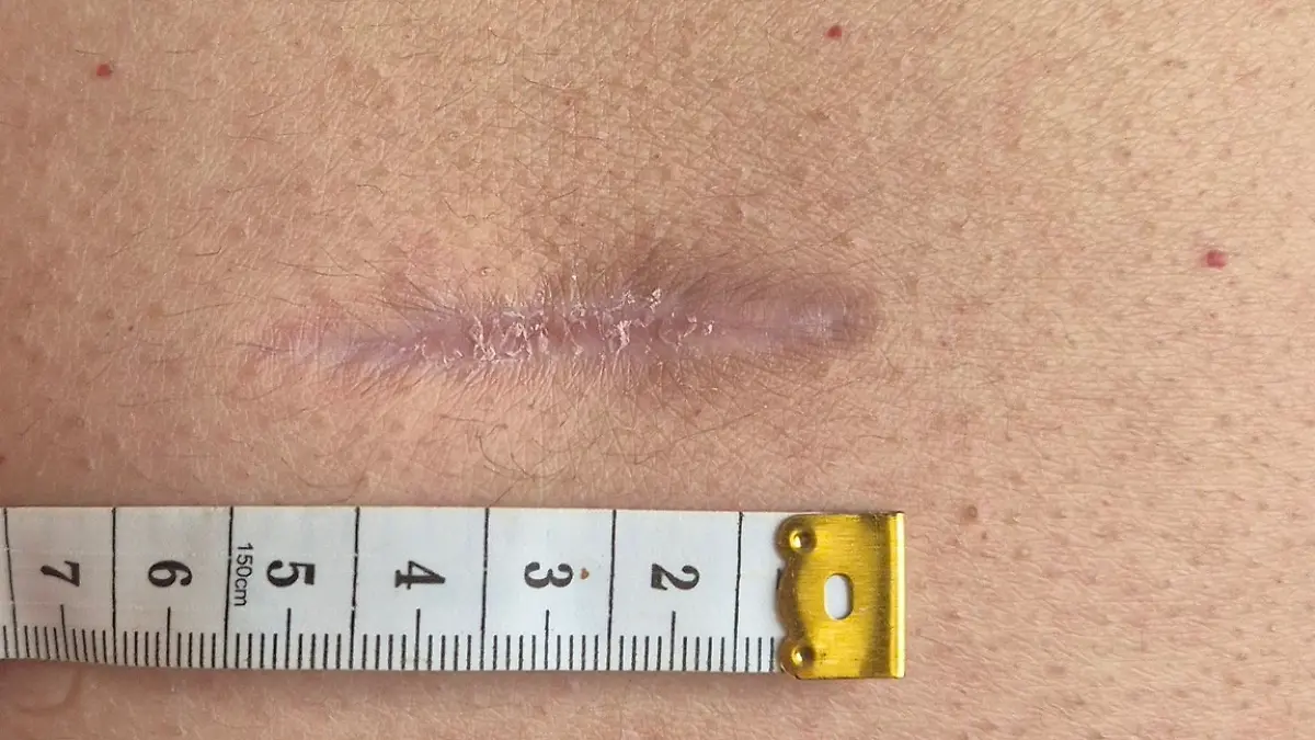 Bauch Narbe Julia Lanni.jpg