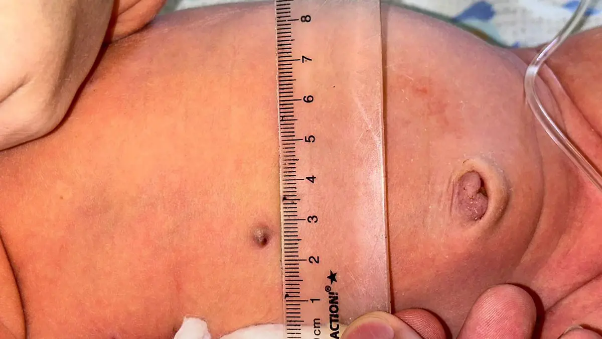 Ein Babybauch mit einem kleinen Metallstück unter der Haut. 
