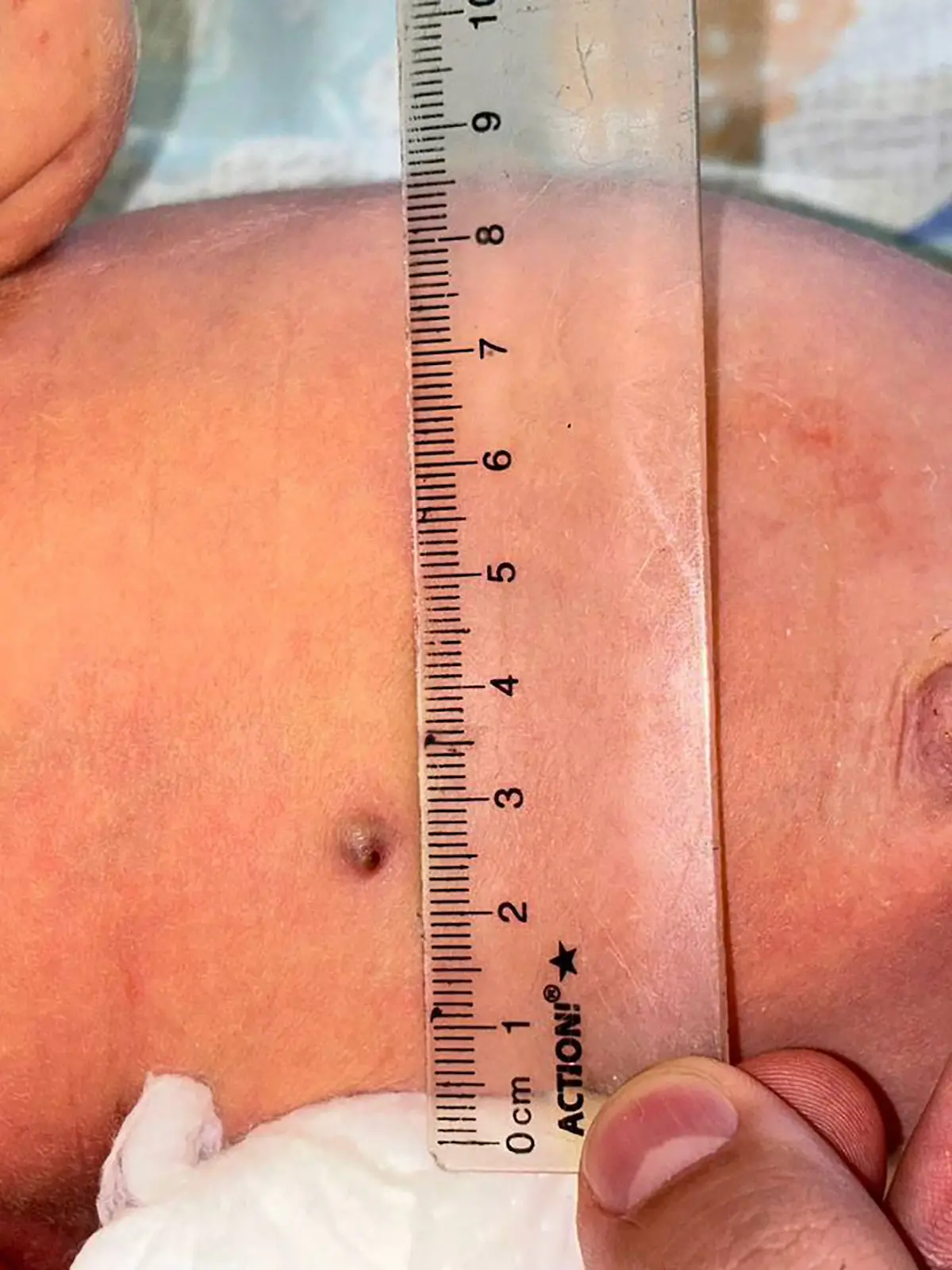 Ein Babybauch mit einem kleinen Metallstück unter der Haut. 
