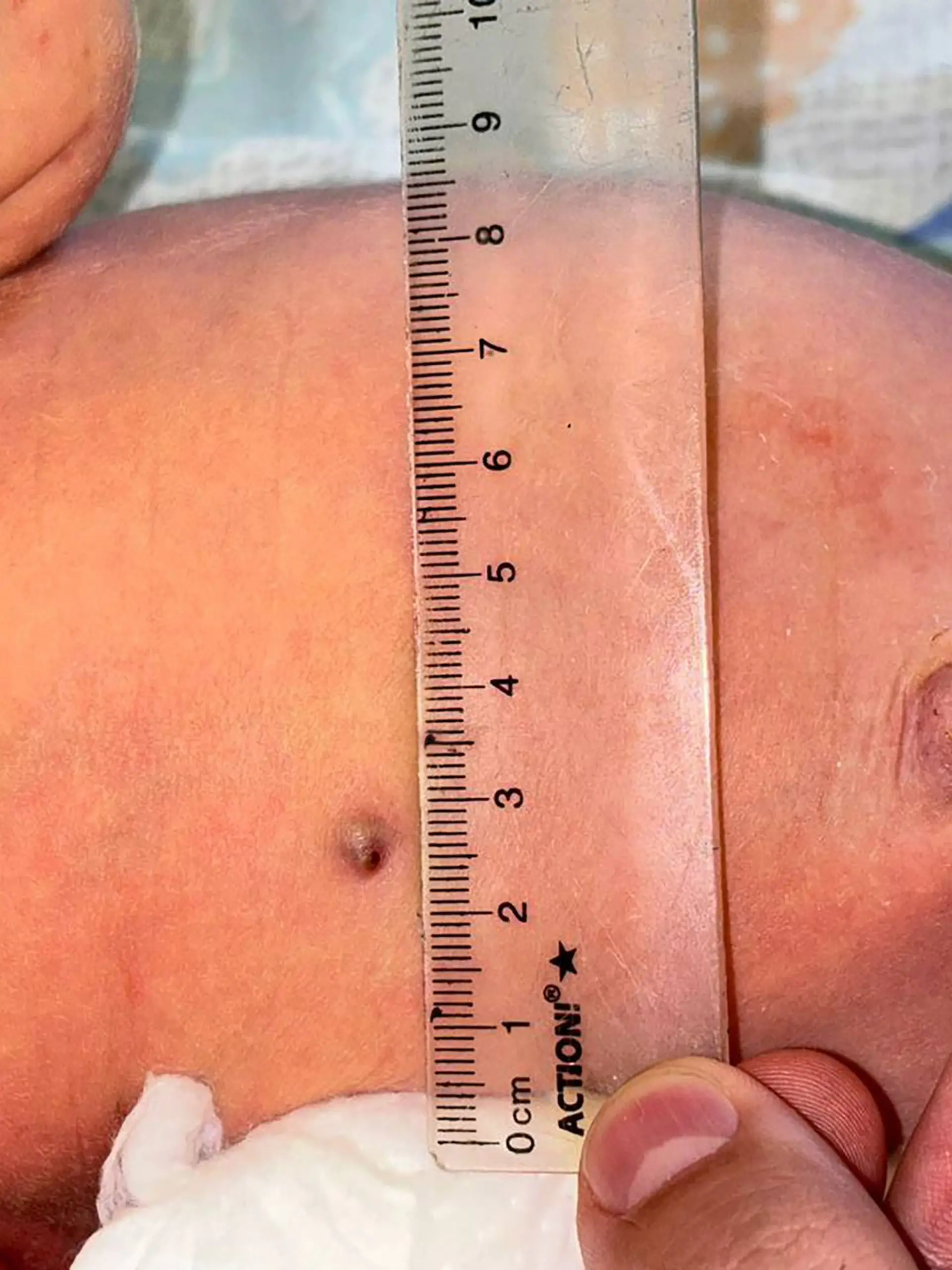 Ein Babybauch mit einem kleinen Metallstück unter der Haut. 