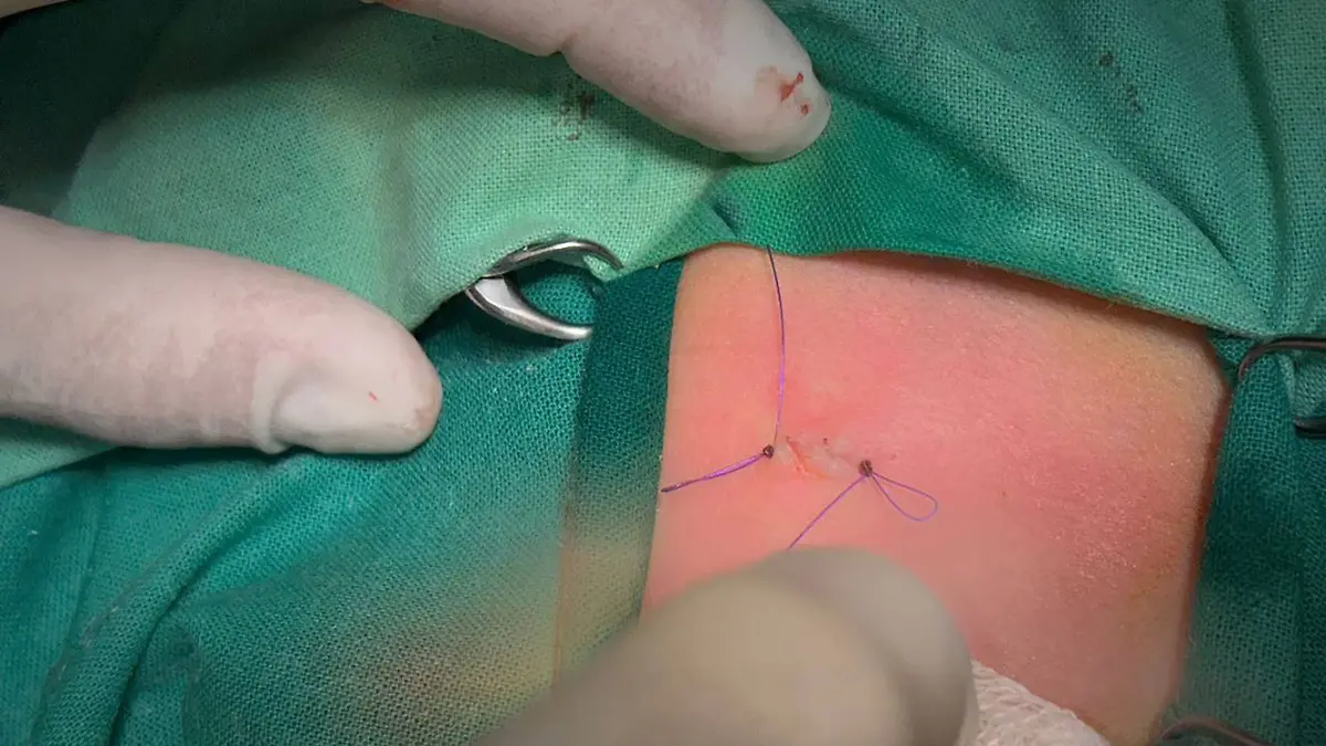 Ein Babybauch mit einer kleinen OP-Wunde. 