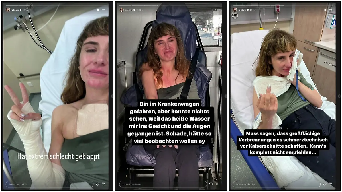 Jule Lobo hat sich verbrannt