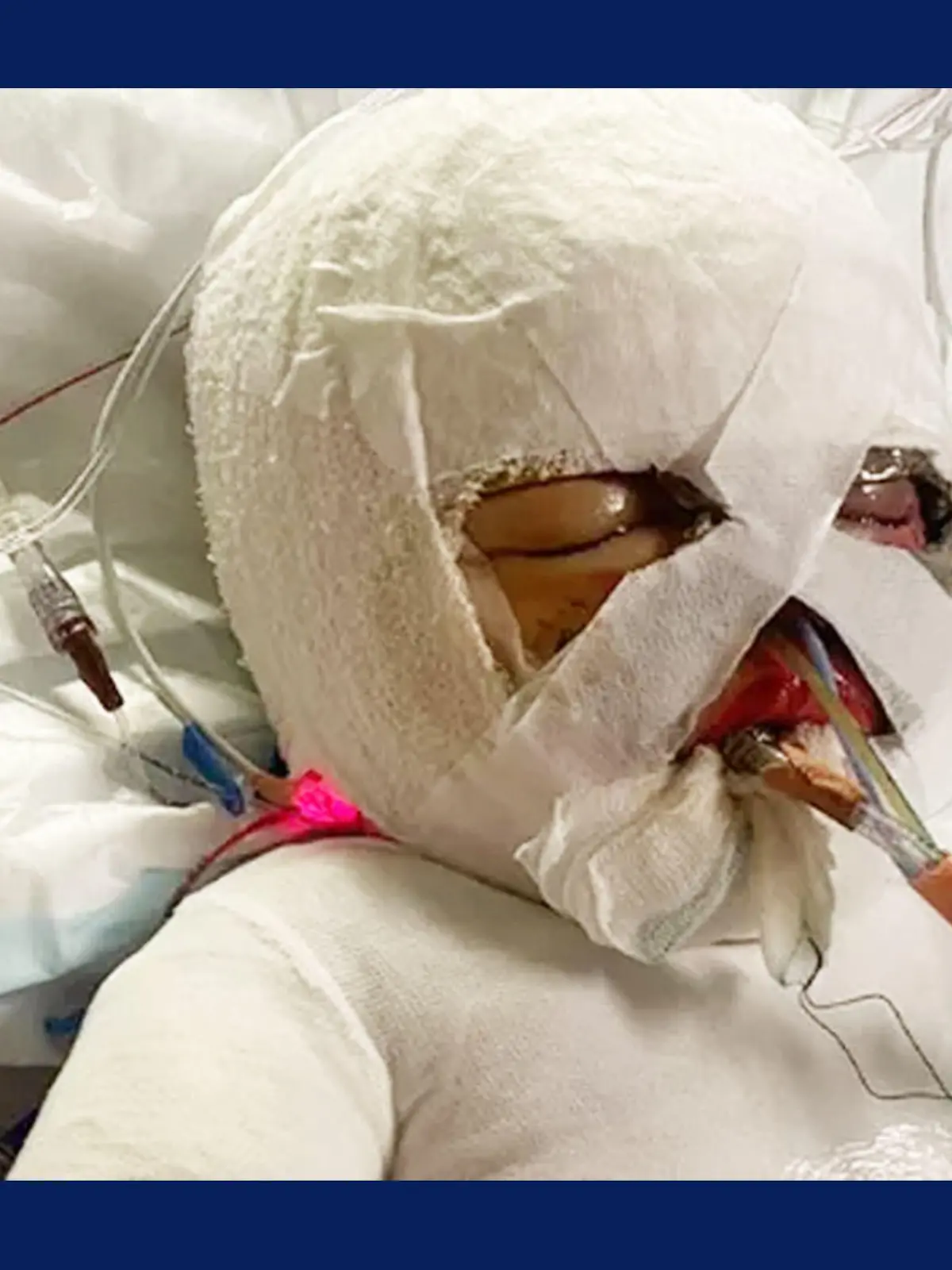 Der kleine Elijah (2) überlebte nur knapp einen Hausbrand. Jetzt liegt der Junge im Krankenhaus.