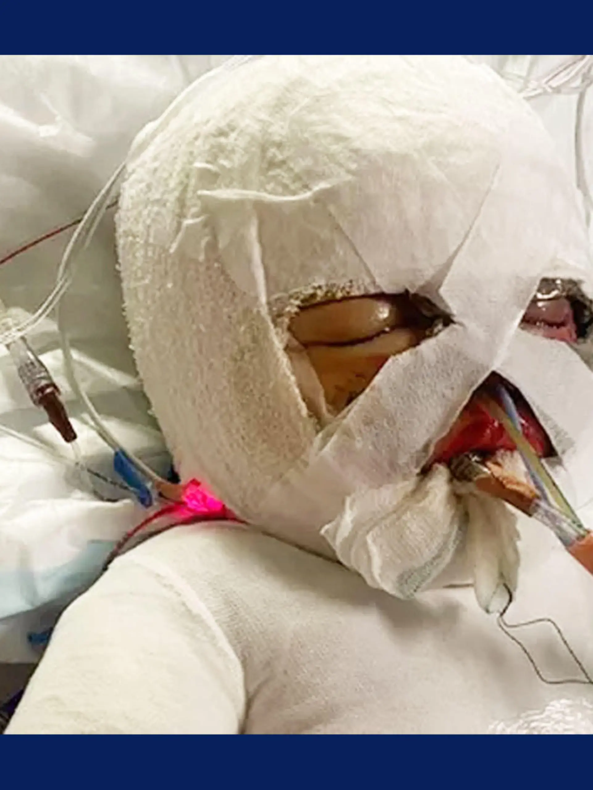 Der kleine Elijah (2) überlebte nur knapp einen Hausbrand. Jetzt liegt der Junge im Krankenhaus.