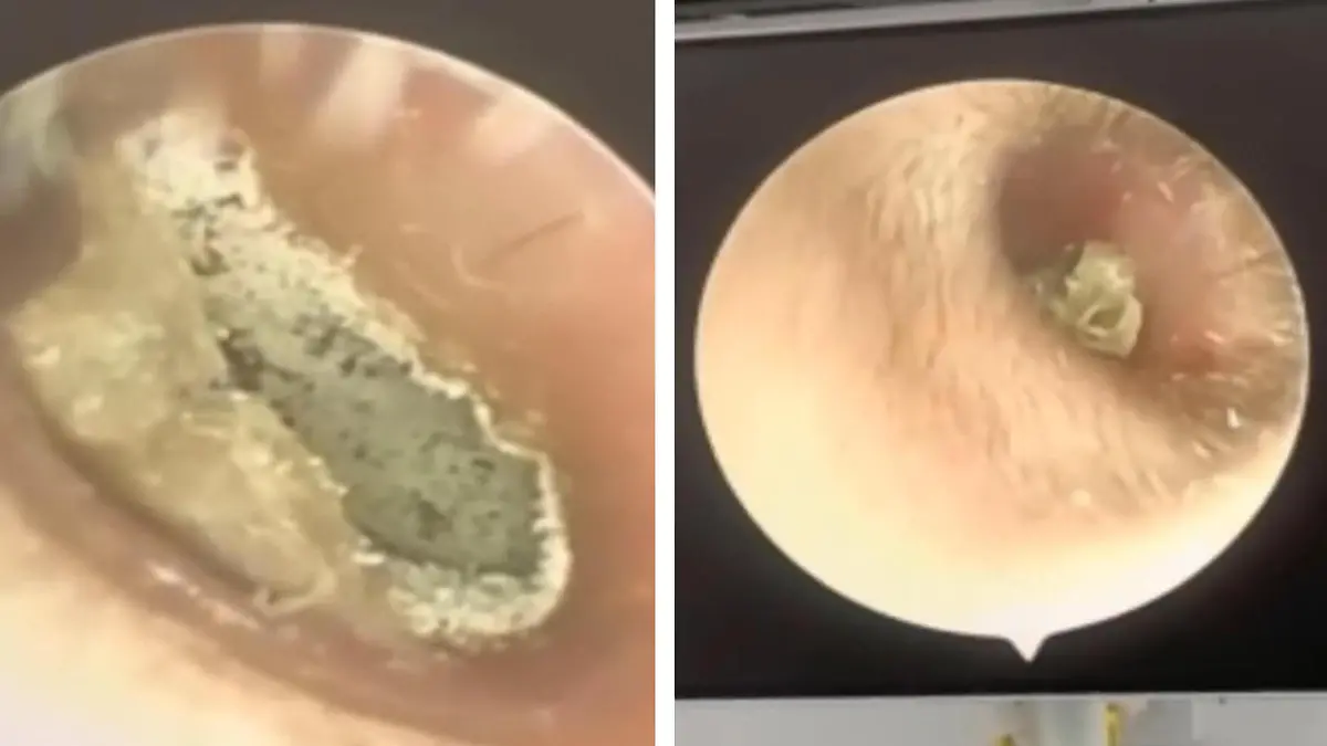 Arzt findet hunderte Mini-Pilze in Ohr